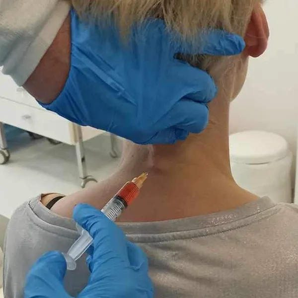 Iniekcja osocza i fibryny